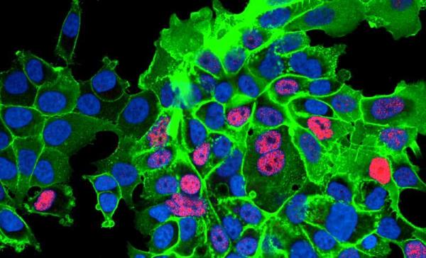 Inflammatory cells in tumour microenviro<em></em>nment transform prostate cancer cells into treatment-resistant cells